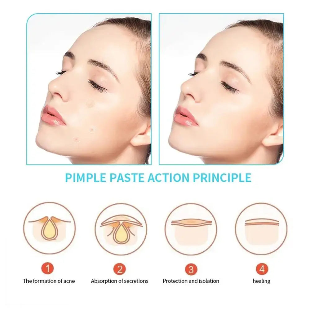 30 pezzi di acne idrocolloide invisibili-rimozione del brufolo impermeabile, trattamento anti-acne, adesivi per la riparazione di cicatrici e cicatrici