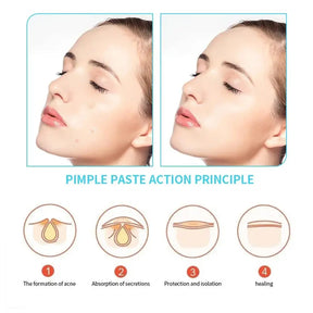 30 PCs Unsichtbare Hydrocolloid-Akne-Flecken-wasserdichte Pickelentferner, Anti-Acne-Spot-Behandlung, Narbenkorrektor und Hautreparaturaufkleber